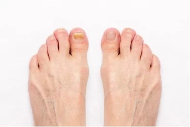 😱Aceite para Uñas Encarnadas💯